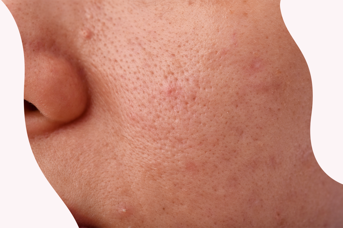 Productos para poros