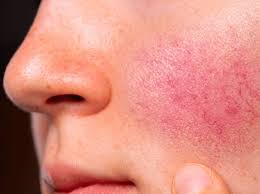 Productos para rosácea